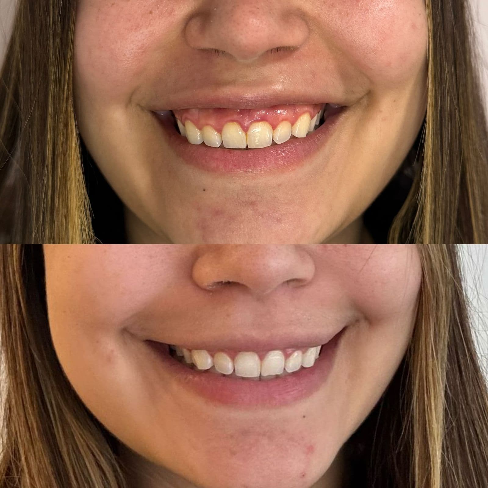 Neuromoduladores: Antes y Después