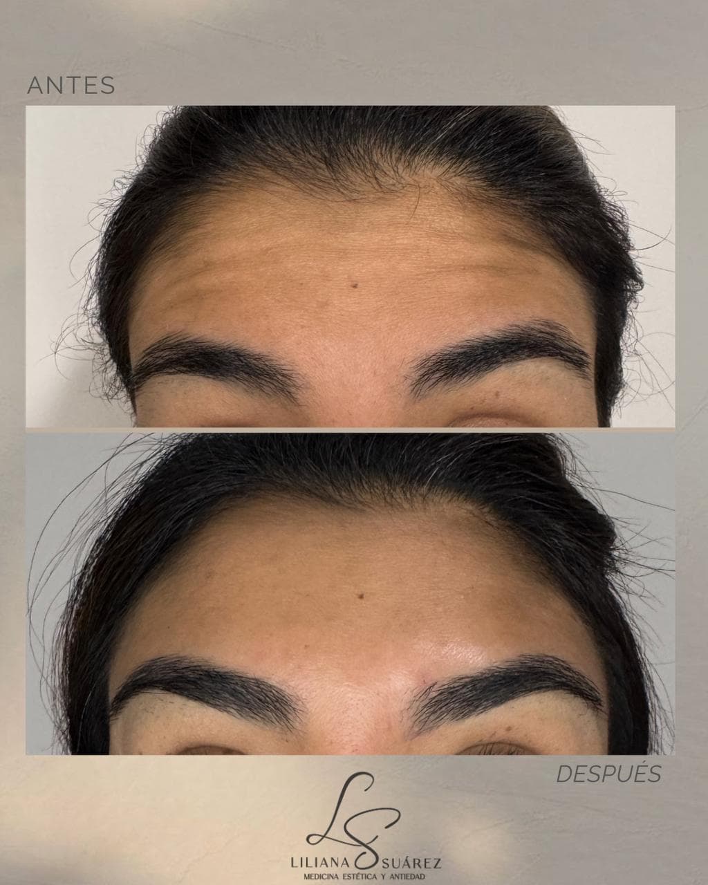 Toxina Botulínica: Antes y Después